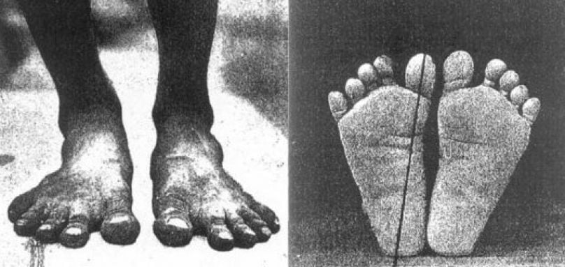 wide bare feet